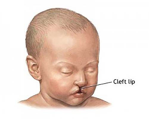 Заячья губа 