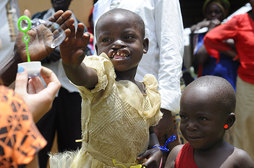 Операция заячьей губы 