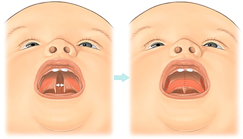 Операция волчьей пасти
