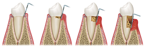Периодонтит