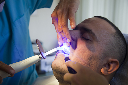 поверхностное окрашивание зуба