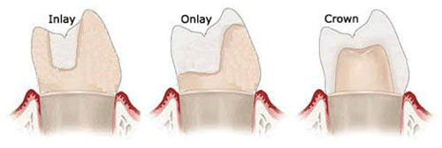 Вкладки и накладки