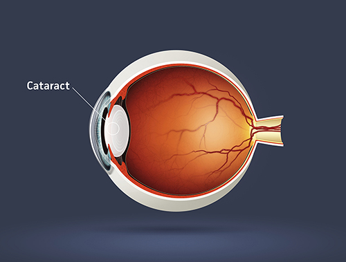 Cataract Treatments