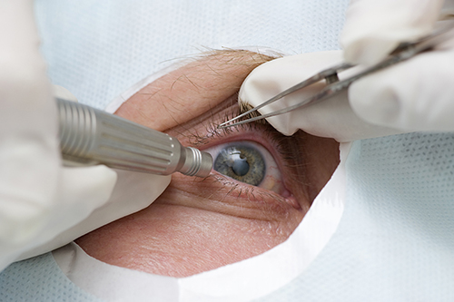 Cataract Surgeries
