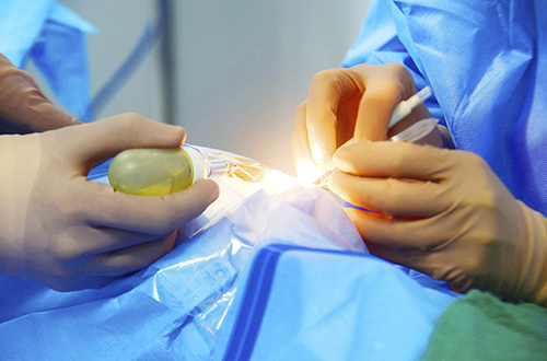 Эксимерный лазер