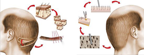 Методы пересадки волос