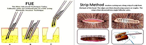 экстракции фолликулярных объединений