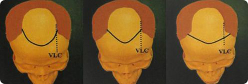 Дизайн передней линии роста волос