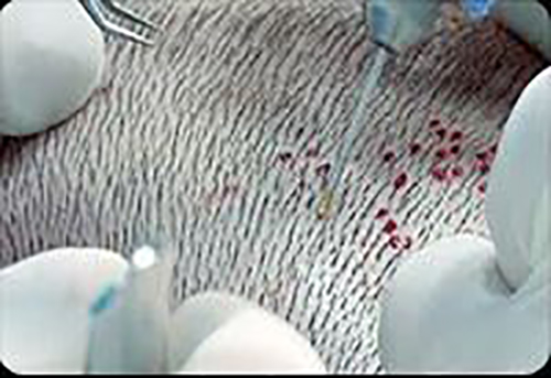 Процедура трансплантации волос