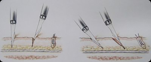 Процедура трансплантации волос
