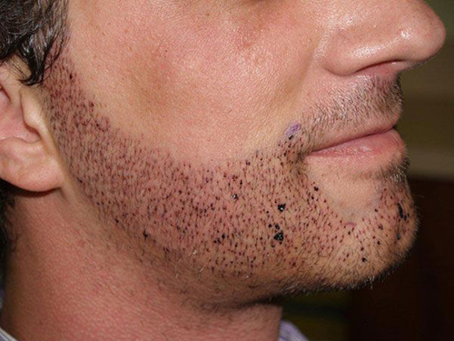 трансплантация бороды