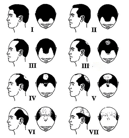 Классификация мужского типа облысения